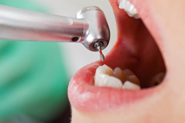 Best Emergency Root Canal Treatment in Maunawili, HI